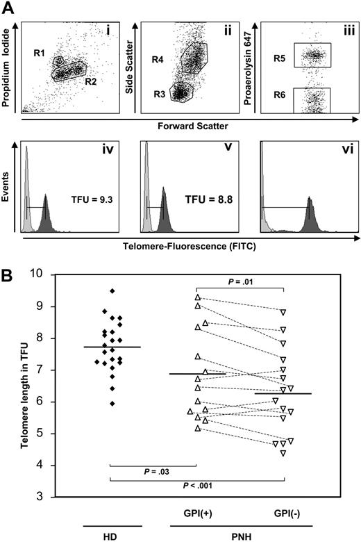 Figure 1. Proaerolysin flow-FISH. (A) Cow cells (R1 in Ai,Avi) can be distinguished from human diploid cells (R2 in Ai) based on PI staining. Lymphocytes (R3 in Aii) and granulocytes (R4 in Aii) were discriminated within diploid cells (R2 in Ai) based on size and granularity (Aii). Granulocytes can be separated into proaerolysin-positive and -negative cells (R5 and R6, respectively, in Aiii). This analysis was performed with (dark-gray peaks in Aiv-vi) and without (light-gray peaks in Aiv-vi) FITC-labeled PNA probes in order to allow subtraction of autofluorescence. (B) Scatter plots of the telomere length measurements of 14 GPI+ and 16 GPI– granulocyte populations determined by proaerolysin flow-FISH in 16 patients with PNH and 22 age-matched healthy donors (HD). The horizontal lines represent the mean values of each group.