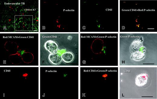 Figure 2. Colocalization of P-selectin and CD41 on platelets adhering to endovascular trophoblasts and cultured EVTs. Sections of placental tissue at 10 weeks of gestation were double stained with rhodamine (red) and FITC (green). Panels B-D are the sequential sections of panel A and higher magnifications of the boxed area indicated in the sequential section of panel A. P-selectin (B; red) was colocalized with CD-41 (C; green) on platelets that adhered to endovascular trophoblasts (A; green). After 24-hour culture of isolated EVTs with platelets, EVTs were detached from the dishes and were double stained. (F,H,L) Phase-contrast images. (E-F) CD41 (green) and CD146/MCAM (red). (G-H) CD62P/P-selectin (green) and CD146/MCAM (red). (I-L) CD62P/P-selectin (green) and CD41 (red). CD41+ platelets were adhered to CD146+ EVTs (E-F). Most of these platelets expressed P-selectin on the cell surface, showing that they had been activated (G-L). Bars show 20 μm. Original magnification × 400 (A), × 800 (panels B-D), and × 1200 (panels E-L).