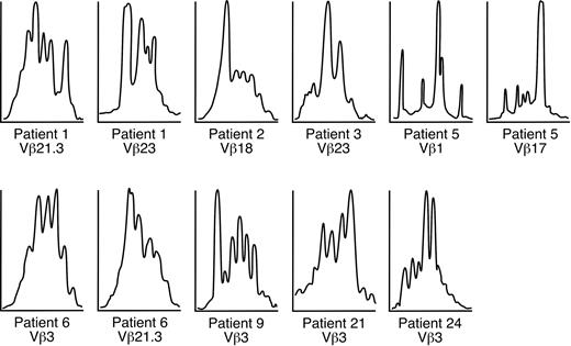Figure 2. Spectratyping performed on trisomy 8 samples. Spectratyping demonstrated skewing of the CDR3 distribution in most expanded CD8+ Vβ subfamilies shown in Table 2.