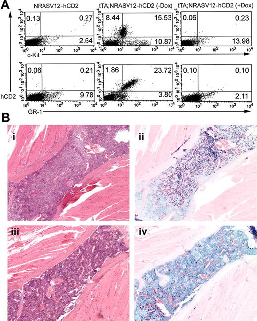 Figure 8. Repressibility of disease in vivo with doxycycline. Five weeks after the start of doxycycline treatment, mice were killed, and spleens and bones were taken for histologic analysis, flow cytometry, and tissue culture. (A) Flow cytometry was performed on single-cell suspensions of spleen tissue. Cells were stained with anti-hCD2 and either anti–c-Kit (top row) or anti–GR-1 (bottom row). Singly transgenic (left column) and doubly transgenic animals were analyzed. A substantial population of c-Kit+, GR-1+ cells, characteristic of mast cells, is present in doubly transgenic mice not treated with doxycycline (middle column), whereas a similar population is absent in mice treated with doxycycline (right column). Representative results are shown, with percentages of positive cells indicated in each quadrant. (B) Histologic analysis showing (i) granulocyte and (ii) mast cell infiltrates in the bone marrow of untreated mice and (iii-iv) reduced infiltration in the bone marrow of treated animals. A single sternal vertebra is shown in each panel. Original magnification, × 10.