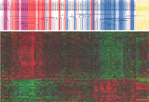Figure 5. Hierarchical clustering of MMCs, BMPCs, and PPCs identifies a signature of BM stroma interaction for TACIhi patients and a plasmablastic signature for TACIlo patients. Unsupervised hierarchical clustering analysis of the expression profile of MMCs of 65 patients at diagnosis, 7 PPC samples, and 7 BMPC samples show that TACIlo MMCs cluster (blue) together with PPCs (yellow) whereas TACIhi MMCs cluster (red) with normal BMPCs (purple). The clustering was performed on the 659 genes differentially expressed between TACIhi and TACIlo MMCs. The TACI40lo, TACI25lo, and TACI15lo subgroups were represented by graded blue color (more intense in TACI15lo) and the TACI40hi, TACI25hi, and TACI15hi subgroups with graded red color (more intense in TACI15hi).