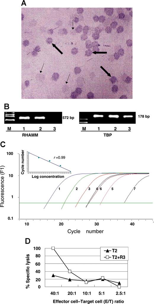 Figure 5. Positive serologic results to RHAMM/CD168, mRNA expression, and specific cellular immune responses against RHAMM/CD168 in a 69-year-old AML patient with a normal karyotype. Positive serologic immune responses against RHAMM/CD168 were detected using the phage plaque assay (A): bold arrows point to positive plaque-forming units (PFUs); thin arrows, to negative PFUs from the background of the cDNA library. Pictures of immunocytological stainings were taken with an Axiophot microscope with 25 × objective lens (Zeiss, Oberkochen, Germany) and a digital camera (JVC, Friedberg, Germany) coupled to a commercially avalable imaging system (Diskus, Königswinter, Germany). Positive mRNA expression was assessed by conventional RT-PCR (B). Lane M represents marker VI; lane 1, AML patient; lane 2, K562; and lane 3, healthy volunteer. In real-time RT-PCR, high expression of RHAMM/CD168 could be detected (C). Curve 1 represents 6.19 × 106 copies; curve 2, 6.19 × 105 copies; curve 3, 6.19 × 104 copies; curve 4, 6.19 × 103 copies; curve 5, 6.19 × 102 copies; curve 6, AML blasts; and curve 7, PBMCs of healthy volunteers (HV). The inset demonstrates the regression analysis with a regression coefficient of 0.99. Specific lysis of T2 cells pulsed with the RHAMM/CD168 R3 peptide occurred as demonstrated in panel D: specific CD8+ T cells generated of MLPC with the RHAMM/CD168-derived peptide R3 were able to lyse R3-pulsed T2 cells but not T2 cells alone.