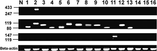 Figure 1. Detection of t(11;18)(q21;q21) by multiplex RT-PCR of the API2-MALT1 fusion transcript. Blots from top to bottom: second PCR-A, second PCR-B, second PCR-C, and beta-actin mRNA amplification. Lane N, negative control (normal lymph node). Lanes 1 to 12, H pylori–independent MALT lymphomas (positive). Lane 13, H pylori–dependent MALT lymphoma (positive). Lanes 14 to 16, H pylori–dependent MALT lymphomas (negative).
