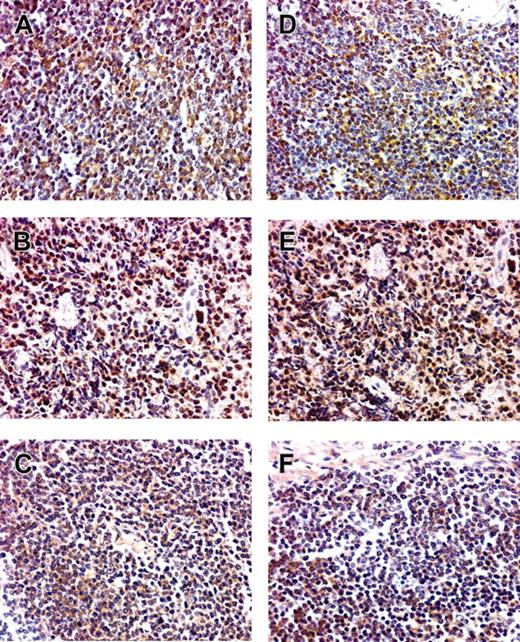 Figure 2. BCL10 and NF-κB protein expression in low-grade gastric MALT lymphomas with and without t(11;18)(q21;q21). (A-C) BCL10. (D-F) NF-κB. (A,D) Nuclear BCL10 and NF-κB expression in H pylori–independent patients with t(11;18)(q21;q21). (B,E) Nuclear BCL10 and NF-κB expression in H pylori–independent patients without t(11;18)(q21;q21). (C,F) Cytoplasmic BCL10 expression and NF-κB expression in H pylori–dependent patients. Original magnification, × 400. An Olympus BX40 microscope equipped with 10×/0.25 and 40×/0.65 objective lenses (Olympus, Tokyo, Japan) was used to visualize images. Pictures were taken with an Olympus DP11 camera, and Adobe Photoshop 6.0 was used to zoom images to their present magnitude (Adobe Systems, San Jose, CA).