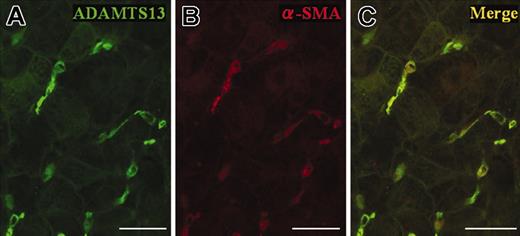 Figure 2. Confocal laser-scanning immunofluorescence microscopy using frozen sections of a liver specimen from a patient with hepatitis C–related chronic hepatitis. Immunofluorescence labeling with anti-ADAMTS13 antibodies showed intense green fluorescence in the perisinusoidal cells, which were irregular in shape with spotty, oval, unipolar, and bipolar cytoplasmic processes extending between the hepatocytes (A). Red fluorescence indicated α-SMA immunoreactivity, reflecting the fact that these cells were activated HSCs (B). Colocalization of ADAMTS13 (A) and α-SMA (B) in single cells yielded yellow color in the merged figure (C). (Original magnification, × 400; bar = 30 μM in A-C.)