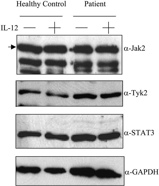 Figure 2. Expression of Jak2, Tyk2, and STAT3 by PBMCs. PBMCs obtained from a healthy control subject (lanes 1-2) and a patient with lymphoma 3 months after transplantation (lanes 3-4) were incubated with or without IL-12 100 U/mL for 1 hour as indicated, lysed, resolved by SDS-PAGE, transferred to nitrocellulose membranes, and immunoblotted using antibodies specific for Jak2, Tyk2, STAT3, or GAPDH as indicated. Location of the specific band for Jak2 is indicated by the arrow. Results are representative of those seen with 4 control samples (4 for Jak2, 2 for Tyk2 and STAT3) and 4 patient samples (4 for Jak2, 2 for Tyk2, 3 for STAT3) that were tested.