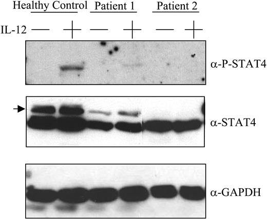 Figure 3. Tyrosine phosphorylation of STAT4 in response to IL-12. PBMCs obtained from a healthy control subject (lanes 1-2) and 3 months after transplantation from 2 patients with lymphoma (lanes 3-6) were incubated with or without IL-12 100 U/mL for 1 hour as indicated, lysed, resolved by SDS-PAGE, transferred to nitrocellulose membranes, and immunoblotted using antibodies specific for tyrosine phosphorylated STAT4, total STAT4, or GAPDH as indicated. Location of the specific band for total STAT4 is indicated by the arrow. The identity of the STAT4 band was confirmed as described in “Patients, materials, and methods.” Results are representative of those seen with 6 control samples and 6 patient samples that were tested.