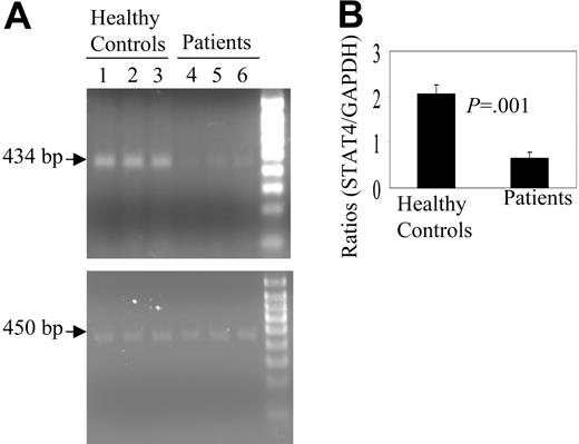 Figure 5. Expression of STAT4 mRNA by PBMCs. (A) Total RNA was extracted from PBMCs of 3 healthy control subjects (lanes 1-3) or 3 patients with lymphoma after transplantation (lanes 4-6), reverse transcribed to cDNA, subjected to 25 cycles of PCR amplification, and resolved by electrophoresis as described in “Patients, materials, and methods.” The specific bands corresponding to the amplified STAT4 cDNA (upper) or amplified GAPDH cDNA (lower) are indicated by arrows. (B) Intensities of the STAT4 and GAPDH bands were measured by densitometry. Values shown are mean ± SD of the ratio of the intensity of STAT4 to GAPDH bands.