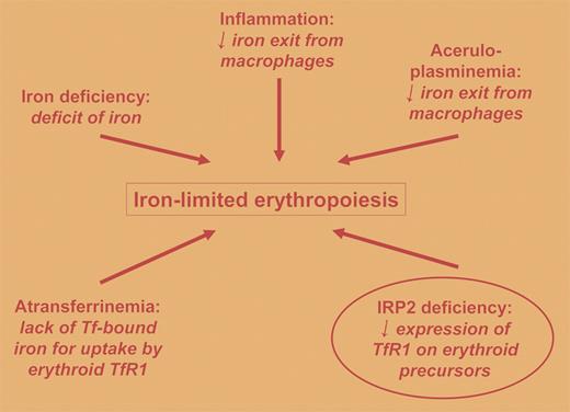 Causes and mechanisms of iron-limited erythropoiesis are summarized. The human conditions are not circled. The contribution to iron-limited erythropoiesis of IRP2 deficiency in mice is circled. Tf indicates transferrin;TfR1, transferrin receptor 1; and IRP2, iron regulatory protein 2.