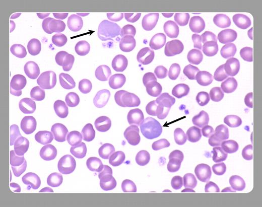 Peter Maslak, Memorial Sloan-Kettering Cancer Center