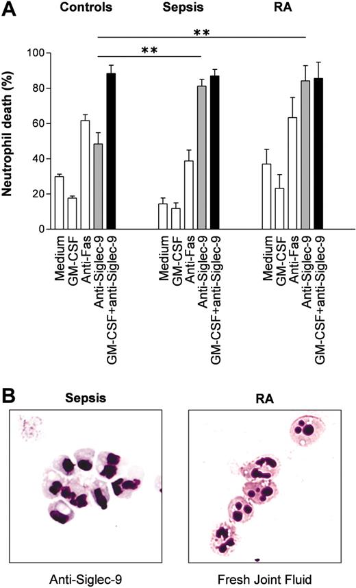 Figure 7. Neutrophils from patients with sepsis and patients with RA demonstrate increased Siglec-9-mediated cell death susceptibility. (A) Blood neutrophils from patients with sepsis and joint fluid neutrophils from patients with RA appeared to be primed in vivo. Additional in vitro priming with GM-CSF had no effect on these inflammatory neutrophils. Results of 20-hour cultures are shown (control individuals: n = 6; septic shock neutrophils: n = 5; joint fluid RA neutrophils: n = 4). **P < .01. (B) Cytoplasmic vacuolization associated with inflammation. (Left) Sepsis blood neutrophils following 15-hour anti-Siglec-9 mAb treatment alone in vitro. (Right) Neutrophils from fresh RA joint fluids. Neutrophils were stained with Giemsa-May-Grünwald (Diff-Quik). Original magnification, × 1000.