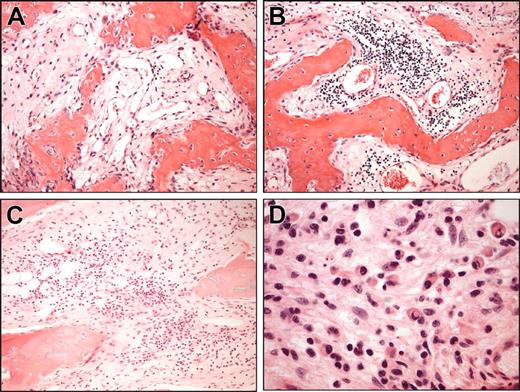 Figure 2. Histologic analysis of human fetal BM sections engrafted with WM cells. Analysis was performed on decalcified fetal bone chips implanted in SCID-hu mice and directly injected with patient unsorted WM cells. Bone chips were retrieved from mice after detection of rising levels of human paraprotein in murine serum and then stained with H&E. Four representative sections show infiltration with small lymphocytes, lymphoplasmacytoid cells, and plasma cells in the context of intramedullary fibrosis and scant residual fetal hematopoiesis. Original magnifications are (A) × 100, (B) × 100, (C) × 100, and (D) × 400.