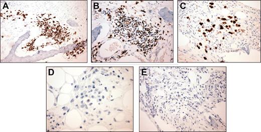 Figure 3. Immunohistochemical analysis of human fetal bone sections engrafted with WM cells. A fetal bone engrafted with IgMκ WM cells was retrieved from murine host after detection of rising levels of human paraprotein in mouse serum and examined. (A) Staining with anti-CD20 monoclonal antibody (mAb; original magnification, × 200), (B) anti-IgM polyclonal Ab (original magnification, × 200), and (C) anti-κ mAb (original magnification, × 200), demonstrates predominantly cytoplasmic reactivity within the plasmacytic component of the tumor only, (D) anti-IgG mAb (original magnification, × 400), and (E) anti-λ mAb (original magnification, × 200).