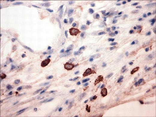 Figure 4. Immunohistochemical analysis for mast-cell tryptase in human fetal BM sections after engraftment of unsorted WM cells. A fetal bone engrafted with IgMκ WM cells was retrieved from murine host after detection of rising levels of human paraprotein in mouse serum and then examined for the presence of mast cells as assessed by immunostaining for mast-cell tryptase. Original magnification, × 400.