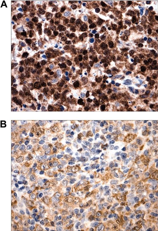 Figure 1. Subcellular localization of c-REL in MLBCL. (A) Prominent intense c-REL nuclear staining in a representative primary MLBCL. (B) Variable c-REL staining intensity and subcellular localization in a DLBCL. Original magnification, × 400.