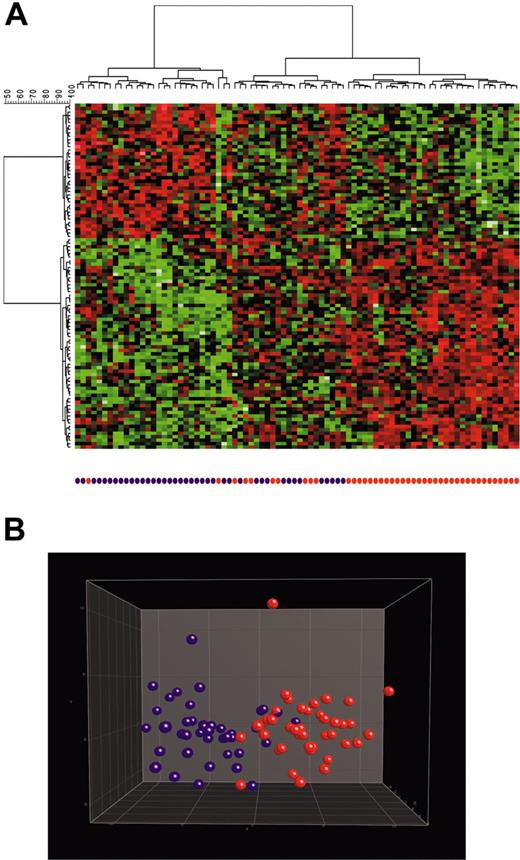Figure 4. Identification of c-ALL/pre–B-ALL samples with or without t(9;22). Analysis of 82 c-ALL/pre–B-ALL samples based on a supervised identification of differentially expressed genes among 42 patients demonstrating a t(9;22)/BCR-ABL and 40 patients without t(9;22). The labels and coloring of the classes were added after the analysis of means for better visualization. (A) In the hierarchical cluster analysis, the normalized expression value for each gene (given in rows) is coded by color (SD from mean). Red cells indicate high expression, and green cells indicate low expression. Most (61 of 82; 74%) patients were in the branch of c-ALL/pre–B-ALL without t(9;22) (left branch) or in the branch of c-ALL/pre–B-ALL with t(9;22) (right branch). The remaining 21 (26%) patients were in a third branch characterized by a gene expression profile clearly different from the 2 other groups (middle branch). (B) In 3-dimensional PCA, the c-ALL/pre–B-ALL samples were projected into the feature space consisting of the top 100 differentially expressed genes when comparing t(9;22)–positive (red) with t(9;22)–negative (purple) patients. Data points with similar characteristics cluster together. A single color-coded sphere represents each patient's expression pattern.