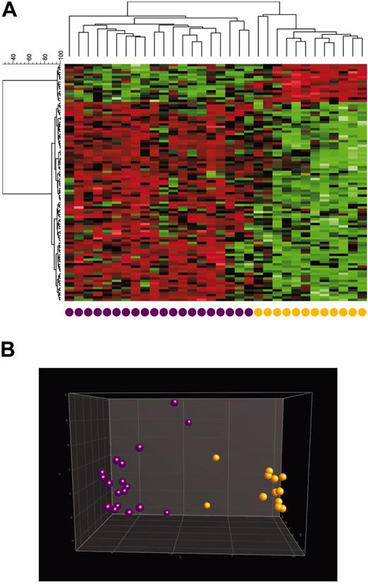 Figure 5. Distinction between immature and cortical T-ALL samples. Analysis of 32 T-ALL samples based on a supervised identification of differentially expressed genes between 12 immature T-ALL samples and 20 cortical T-ALL samples. Labels and coloring of the classes were added after analysis for better visualization. (A) In hierarchical cluster analysis, the normalized expression value for each gene (given in rows) is coded by color (SD from mean). Red cells indicate high expression, and green cells indicate low expression. (B) In 3-dimensional PCA, T-ALL samples were projected into the feature space consisting of the top 100 differentially expressed genes when comparing patients with immature (orange) and cortical (purple) T-ALL. Data points with similar characteristics cluster together. A single color-coded sphere represents each patient's expression pattern.