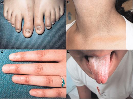 Figure 1. Clinical features of a patient (F17) with dyskeratosis congenita. (A) Nail dystrophy, (B-C) abnormal skin pigmentation, and (D) mucosal leucoplakia.