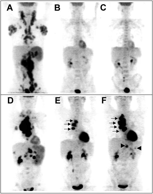 Figure 2. Example of sequential FDG-PET findings in 2 patients. Panels A-C show scans from a patient with truly negative “early PET,” predicting CR. (A) Pretherapeutic scan shows diffuse involvement of jugular chains, axillae, mediastinum, mesenteric chains, spleen, and lateroaortic and iliac chains. No residual uptake is seen after 2 cycles (B) and after 4 cycles (C) of chemotherapy, whereas a medullar uptake is evidenced, due to hematopoietic activation. Panels D-F show scans from a patient with truly positive “early PET,” predicting relapse. (D) Pretherapeutic scan shows a cluster of hypermetabolic nodes in the right pulmonary hilum, supraclavicular and mesenteric nodes, and involvement of the spleen, right lung, liver, and lumbar spine. Three hilar foci persist after 2 cycles (E, arrows); their extent increases after 4 cycles (F, arrows), whereas subdiaphragmatic sites reappear (arrowheads), indicating progression of the disease.