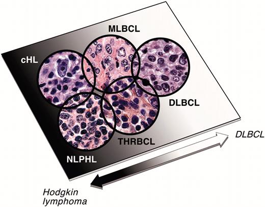 Figure 4. DLBCL, gray zone lymphomas, and Hodgkin lymphomas. MLBCL and T-cell/hisotcyte–rich large B-cell lymphoma (T/HRBCL) are considered “gray zone lymphomas,” which share characteristics of large B-cell lymphomas and Hodgkin lymphomas (cHL and NLPHL, respectively), including increased host inflammatory response. The similarities among these entities points to a group of tumors defined, and possibly driven, by their interaction with the host microenvironment. Images provided by J. Kutok, Department of Pathology, Brigham and Women's Hospital, Boston, MA. The samples were analyzed using an Olympus BX41 microscope equipped with 40×/0.75 and 20×/0.50 Olympus UPlanFL objective lenses (Olympus, Melville, NY). Pictures were taken using Olympus QColor3, and were analyzed with QCapture 2.60 software (QImaging, Burnaby, BC, Canada). Adobe Photoshop 6.0 was used to process images (Adobe, San Jose, CA).