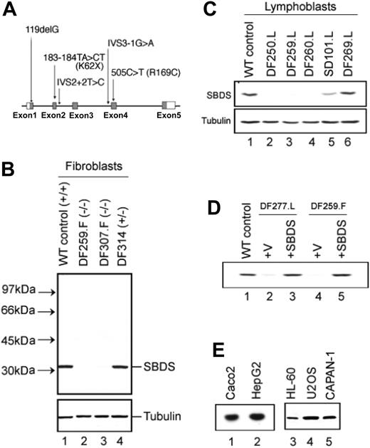 Figure 1. Patients with SDS express variable levels of SBDS protein. (A) Schematic diagram of SBDS mutations. The locations of the SBDS mutations identified in our patient series are diagramed (not drawn to scale). The SBDS gene is composed of 5 exons (depicted with boxes). The translated mRNA regions are shaded gray. (B) SBDS expression in fibroblasts. Bone marrow fibroblast protein lysates were analyzed by immunoblotting for SBDS protein (top). The SBDS genotypes of each cell line are indicated in parentheses. The blot was also probed for tubulin to ascertain equivalent protein loading (bottom). DF259 and DF307 harbored SBDS mutations predicted to lead to premature translation termination. The wild-type (WT) control (NMF-100) is a marrow fibroblast cell line derived from a healthy control patient. (C) SBDS expression in lymphoblasts. Lymphoblast protein lysates were analyzed by immunoblotting for SBDS protein (top) and tubulin (bottom). DF250, DF259, and DF260 carried SBDS mutations predicted to lead to premature translation termination. SD101 carried a missense (R169C) mutation on 1 SBDS allele. DF269 is derived from a patient with SDS who lacked any identified SBDS mutations. (D) Retroviral transduction of the SBDS cDNA restores SBDS protein expression. A lymphoblast (DF277.L) or fibroblast (DF259.F) SDS cell line was infected with a pBabe retrovirus containing a wild-type SBDS cDNA (lanes 3 and 5) or empty vector (lanes 2 and 4). Cell lysates were immunoblotted for SBDS protein. A normal lymphoblast control cell line (DF213) was run in lane 1 (WT control). (E) SBDS protein is expressed in a variety of tissues. Lysates from the indicated human cell lines were immunoblotted for SBDS protein expression. Caco2 indicates intestinal epithelial cell line; HepG2, hepatocellular carcinoma cell line; HL-60, myeloid leukemia cell line; U2OS, osteosarcoma cell line; CAPAN-1, pancreatic adenocarcinoma cell line.