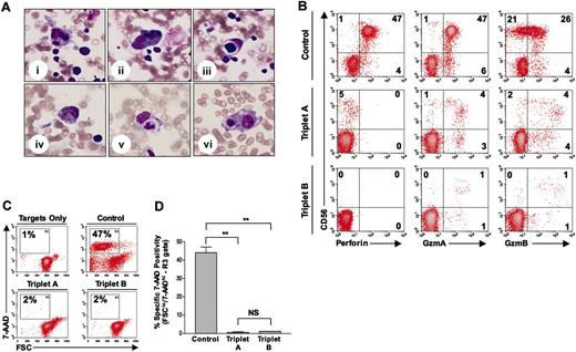 Figure 1. Hemophagocytosis and lack of perforin detection and NK-cell cytotoxicity in case reports A and B. (A) Bone marrow evaluation of triplet A (case report A; i-iii) and triplet B (case report B; iv-vi), showing hemophagocytosis of bone marrow elements (eg, red blood cells and neutrophils) by histiocytes. All pictures are from May-Grünwald/Giemsa–stained slides and are shown at × 400 magnification. (B) Perforin and granzymes A and B antibody reactivity in CD56+CD8– NK cells from control (top row), triplet A (middle row), and triplet B (bottom row). Percentage of positive cells is shown in each quadrant. GzmA indicates granzyme A; GzmB, granzyme B. (C) Representative flow-based cytotoxicity results, demonstrating NK-cell–induced apoptosis (FSClo/7-AAD+hi) of major histocompatibility complex (MHC) class I–negative target cells (K562) in control, triplet A, and triplet B. Percentage of apoptotic target cells is shown in the R3 gate of each panel. FSC indicates forward scatter; 7-AAD, 7-aminoactinomycin D. (D) Summary of NK-cell killing, demonstrating the average percentage of apoptotic target cells detected in the R3 gate for each subject. Effector-target (E / T) ratio was 50:1 for all samples. Values shown are the mean ± SD. **P < .01, NS = not significant.