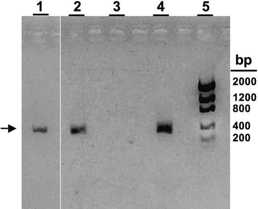 Figure 2. PCR analysis of buffy coat and CSF samples from affected triplets for HHV-8. Specific PCR product for ORF-26 of HHV-8 is shown (336-bp product; arrow).9 Lane 1, triplet B CSF sample; lane 2, triplet A buffy coat sample; lane 3, Mewo cell line (negative control); lane 4, BC-3 cell line (positive control); lane 5: DNA bp ladder.