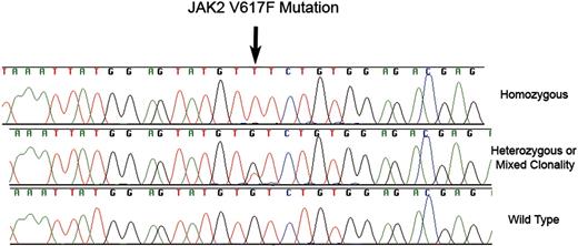Figure 1. JAK2 V617F mutations. Fluorescent dye chemistry sequencing chromatograms showing homozoygous (top) and heterozygous/mixed clonality (middle) guanine to thymine substitution (arrow) in exon 12 of JAK2 in granulocyte genomic DNA from 2 patients with MDS. The predicted protein consequence is substitution of phenyalanine for valine at position 617 of NP_004 963. The bottom chromatogram is the wild-type sequence.