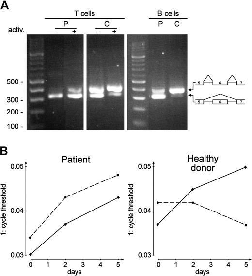 Figure 3. RT-PCR products of CD95 and CD95-del6 mRNA. (A) RT-PCR before (–) and after (+) activation (5 days as in Figure 2) of PBMCs (T cells) and of EBV-transformed B cells (B cells, n = 5). P, patient; C, healthy donor; primers: CF2, CR2. (B) Real-time TaqMan RT-PCR of the splice product containing exon 6 (—) and of the alternatively spliced mRNA without exon 6 (- - -), both from PBMCs. Primers and probes: TF1, P1,TR1; TF2, P2, TR2; abscissa: days of activation; ordinate: reciprocal cycle threshold. The same experiment was performed with EBV-transformed B cells (same result as on day 5, n = 3, not shown).