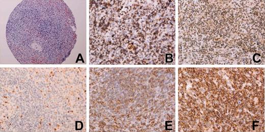 Figure 3. Images from immunostaining of several markers in the TMA. (A) Hematoxylin and eosin (H&E) of a 1-mm diameter cylinder of an SMZL case; (B) CD38; (C) p-IκBα; (D) Ki67; (E) p65; (F) Syk. Original magnifications and numerical apertures 100 ×/0.30 (A) and 400 ×/0.75 (B-F).
