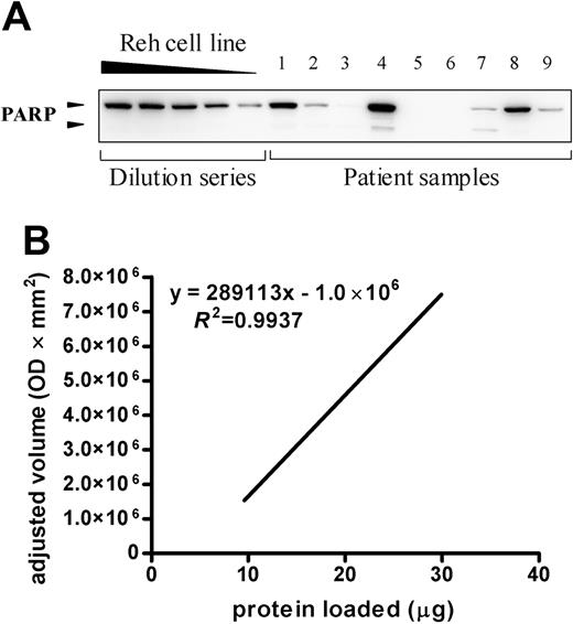 Figure 1. Quantification of apoptotic proteins in newly diagnosed childhood acute leukemia. A representative blot for cells of 9 acute leukemia samples incubated with monoclonal anti-PARP antibody is depicted in the top panel. The dilution series consists of 30, 25, 20, 15, and 10 μg Reh protein lysate. The presence of PARP was detected by enhanced chemiluminescent staining and the signal intensity was quantified by densitometry and plotted (bottom). This graph was used to estimate the relative quantity present in the patient's sample compared with the Reh cell line dilution series by linear regression. The 9 samples shown here are part of the group of 53 patients and include 3 B-lineage ALL samples, 3 T-lineage ALL samples, and 3 AML samples. OD indicates optical density.