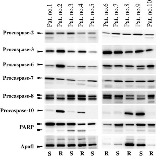 Figure 3. Variation in expression of 8 apoptotic proteins in PRED, VCR, and ASP (PVA)-sensitive and -resistant childhood ALL. Protein levels of Apaf-1, procaspases-2, -3, -6, -7, -8, -10, and PARP of leukemic cells from 10 patients compared by Western blot analysis. Arrows indicate the positions of full-length procaspase-2 (48 kDa), procaspase-3 (32 kDa), procaspase-6 (33 kDa), procaspase-7 (35 kDa), procaspase-8 (50/55 kDa), procaspase-10 (58 kDa), full-length and cleaved PARP (116/89 kDa), and Apaf-1 (140 kDa). The in vitro drug responsiveness of each patient is indicated below each lane; R indicates in vitro resistant and S indicates in vitro sensitive toward PRED, VCR, and ASP (PVA), as explained in “Materials and methods.”