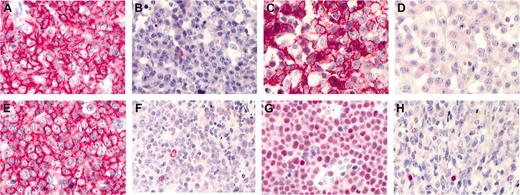 Figure 1. Immunohistochemical staining, APAAP method. (A) DLBCL, centroblastic subtype, CD20 staining with positive tumor cells, × 40; (B) Burkitt-like lymphoma, CD20 staining with negative tumor cells and positive reactive lymphocytes, × 40; (C) DLBCL, centroblastic subtype, CD10 staining with positive tumor cells, × 40; (D) plasmablastic lymphoma, CD10 staining with negative tumor cells, × 40; (E) DLBCL, immunoblastic subtype, CD138 staining with positive tumor cells, × 40; (F) DLBCL, CD138 staining with negative tumor cells and positive reactive plasma cells, × 40; (G) Burkitt lymphoma, MUM1 staining with positive tumor cells, × 40; (H) DLBCL, centroblastic subtype, MUM1 staining with negative tumor cells and positive reactive plasma cells, × 40. Images were visualized in Zeiss Immersol S18N under an Axioskop 2 Plus microscope (Zeiss, Oberkochen, Germany) equipped with a Plan Apochromat 40 ×/1.0 oil objective lens; the iris aperture was 1.0. A Sony 3 CCD color video camera MC3289 (Sony, Tokyo, Japan) and DSH Bilddatenbank software (Greifenstein, Germany) were used for image acquisition.