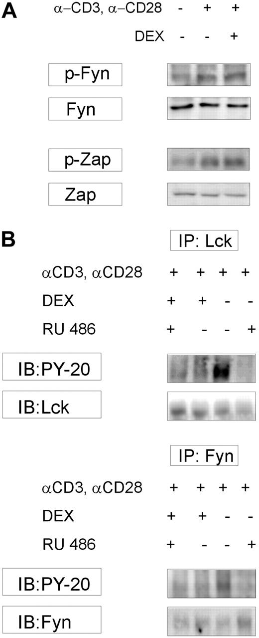 Figure 6. DEX-induced inhibition of Lck and Fyn kinase activities is GR dependent. (A) GR-negative Jurkat cells (confirmed by Western blot analysis; not shown) were pretreated with DEX for 10 minutes and incubated with anti-CD3, anti-CD28 mAbs for 15 minutes. Whole-cell lysates were used for Western blot analysis. Because there are no Abs commercially available targeting phospho-Lck associated with increased activity, phospho-ZAP70 expression (a downstream target of Lck) was analyzed. DEX treatment did not affect phospho-Fyn expression, nor did it affect phospho-ZAP70 protein levels in GR-negative Jurkat cells. Three experiments were performed, and similar outcomes were obtained. (B) CD4+ T cells were incubated for 1 hour with a GR mimetic (RU486; 50 μM), which acts as a GR agonist at this concentration. Subsequently, cells were treated with DEX (10 minutes) and activated with anti-CD3, anti-CD28 Abs (15 minutes). Lck and Fyn immunoprecipitates were subjected to in vitro kinase assay, and phospho-SAM68 expression was studied on Western blot using PY20. Decreased phospo-SAM68 expression was seen in Lck and Fyn immunoprecipitates prepared from activated cells treated with DEX, and cells treated with RU486 together with DEX. Incubation with RU486 alone (at this high/agonistic concentration) also resulted in impaired SAM68 phosphorylation. DEX indicates dexamethasone; IB, immunoblotting; IP, immunoprecipitation.