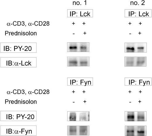Figure 7. Glucocorticoid-induced inhibition of Lck/Fyn enzymatic activity in vivo. Human PBMCs were isolated from whole blood obtained from 2 (no. 1, no. 2) healthy volunteers before and 1 hour after oral administration of 20 mg prednisolone. Next, cells were stimulated ex vivo for 15 minutes with anti-CD3 and anti-CD28 Abs and subjected to immunoprecipitation for Lck and Fyn. After performing in vitro kinase assays, lysates were analyzed on Western blot for SAM68 phosphorylation. Suppressed phospho-SAM68 expression in both Lck and Fyn immunoprecipitates was observed at 1 hour after prednisolone administration in both individuals. IB indicates immunoblotting; IP, immunoprecipitation.