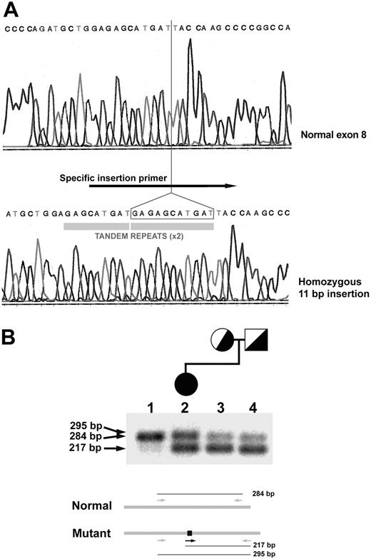 Figure 1. Genetic analysis of the mutational insertion at exon 8 of the PKLR gene. (A) PKLR DNA sequence analysis of healthy exon 8 compared with patient exon 8. The homozygous 11-bp insertion site at the propositus exon 8 and the oligonucleotide primer used in multiplex RT-PCR are indicated. (B) Multiplex RT-PCR amplification using the specific insertion primer. Three different fragments were obtained: a single 284-bp fragment from the normal sequence (lane 1) and 2 mutant fragments (217 bp and 295 bp) from the insertional allele. Diagram below shows the multiplex assay. The patient (lane 2) is homozygous for the mutant allele. Her mother (lane 3) and father (lane 4) are heterozygous for the wild-type and mutant alleles.