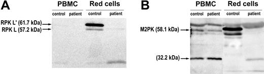 Figure 2. Immunodetection of RPK in the circulating erythroid fraction and peripheral mononuclear cells. (A) Western blot analysis using mouse antibodies against recombinant human RPK on PBMCs and red cells from a healthy control and the patient. The 11-bp insertion resulted in the lack of the wild-type subunit bands (61.7 and 57.2 kDa) from the red cell fraction of the patient. (B) Western blot analysis performed on the same set of samples using antibodies against recombinant human RPK raised in rabbits detecting the RPK (61.7 and 57.2 kDa) and the M2PK (58.1 kDa) wild-type subunit bands. M2PK was detected in PBMCs from the control and the patient, but not in the corresponding RBC fractions. The top extra band in all the tracks has a molecular weight not corresponding to any PK species and was interpreted as an unspecific reaction of this rabbit antibody. If the 32.2-kDa band detected in the PBMC was a degradation product of M2PK, the same band appearing in the erythroid fraction from the patient but absent in the healthy control could be attributable to the presence of M2PK relics from the abundant erythroblasts in the patient's erythroid fraction. It should be noted that reticulocytes/erythroblasts, mainly in the patient, could have been present in the mononuclear cells and mature red cell fractions when separation was performed by centrifugation. Molecular weights for the RPK monomers were calculated according to published data.30