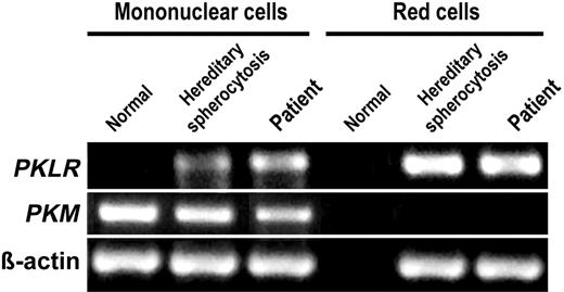 Figure 3. mRNA expression analysis of RPK and M2PK by RT-PCR in peripheral mononuclear cells and red cells. An RPK-mRNA band was detected in red and mononuclear cell fractions from the patient and a control patient with hereditary spherocytosis, yet it was undetectable in fractions from a healthy control. The M2PK-mRNA band was only found in the mononuclear cell fraction of all 3 samples. β-Actin mRNA expression was used as an internal control for all the sample sets. It should be noted that PKLR mRNA from reticulocytes/erythroblasts, mainly from the patient and a control with hereditary spherocytosis, could be present in the mononuclear cell fraction.