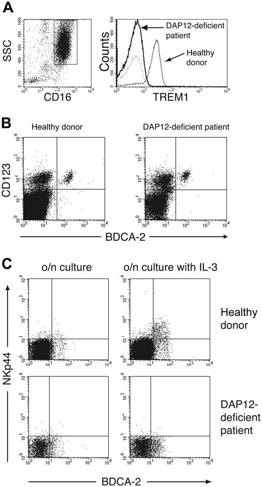 Figure 4. DAP12-deficient IPCs do not express NKp44. (A) To confirm DAP12 deficiency, we evaluated granulocytes for expression of TREM-1, a DAP12-associated receptor (right). TREM-1 expression was determined by gating on CD16+ side scatter (SSC) high granulocytes (left). (B) The presence of IPCs in DAP12-deficient PBMCs was confirmed by analyzing PBMCs for expression of BDCA-2 and CD123. Lineage-positive cells (CD3+, CD14+, CD16+, CD20+, CD56+) were excluded from the analysis. (C) Total PBMCs from a healthy donor and the DAP12-deficient patient were cultured overnight in the presence (right) or absence (left) of IL-3. Selective expression of NKp44 on IPCs was evaluated by counterstaining with BDCA-2. CD19+, CD14+, and CD56+ cells were excluded from the analysis.