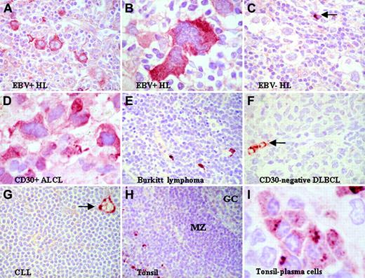 Figure 3. Expression of autotaxin in lymphoid tissues. (A-B) Strong reactivity for autotaxin in HRS cells from EBV-positive primary HL tumors. (C) Lower levels of autotaxin expression in EBV-negative HRS cells despite strong labeling of nontumor cells (arrow). The difference in expression between EBV-negative and EBV-positive tumors was highly significant (see “Expression of autotaxin in primary lymphoma tissues”). In B-NHL, autotaxin expression was largely restricted to CD30+ ALCL (D), whereas most high-grade B-NHLs, such as BL (E) and CD30- DLBCL (F), and low-grade B-NHLs, such as chronic lymphocytic lymphoma (CLL) (G), were negative. (F-G, arrows) Strong labeling of endothelial cells. This restricted pattern may be partly attributed to the finding that among normal B cells, autotaxin expression was absent from germinal center (GC) and mantle zone (MZ) (H) but was expressed by CD138+ postgerminal center B cells (I). Images were acquired using Nikon TE2000 with 60 ×/1.4 NA oil immersion lens (Nikon, Kingston-upon-Thames, United Kingdom). Cells were stained with immunoperoxidase. Images were captured with a Nikon Coolpix 2100, and Paint Shop Pro 8.0 (Jase Software, Maidenhead, United Kingdom).