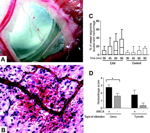 Figure 7. ANCAs induce postcapillary venular hemorrhage. Intravital microscopy was performed on WKY rats 6 to 7 weeks after immunization with hMPO (EAV rats) or HSA (control rats) (C) or on naive WKY rats with infusion of ANCA-rich or ANCA-negative Ig (D). A representative macroscopic image of petechiae around a mesenteric arcade is shown in panel A (× 4; image captured with a Canon IXUS 400; Canon, Tokyo, Japan). The microscopic appearance of this is shown in panel B (H&E stain, UplanApo 20×/0.70 NA). In the active immunization model (C), superfusion with 3 × 10-9 M CXCL1 was maintained for 90 minutes, and hemorrhage was quantified by expressing the number of hemorrhagic venular segments as the percentage of total segments studied at each time point. The data represent the median, interquartile range (box), and range (error bars, n = 11 in control group and 13 in EAV group). Of note, although minor degrees of hemorrhage were seen in the control group, the median remained at zero throughout the experiment. In the passive transfer model (D) superfusion fluid was changed in some experiments from Tyrode solution to CXCL1 30 minutes after Ig infusion, and hemorrhage was quantified after a further 90 minutes using a global mesenteric visual/analog score (n = 4-10 separate rats in each group). Statistically significant differences between groups of rats are shown by asterisks, *P < .05. Data in panels C and D are mean ± SEM.