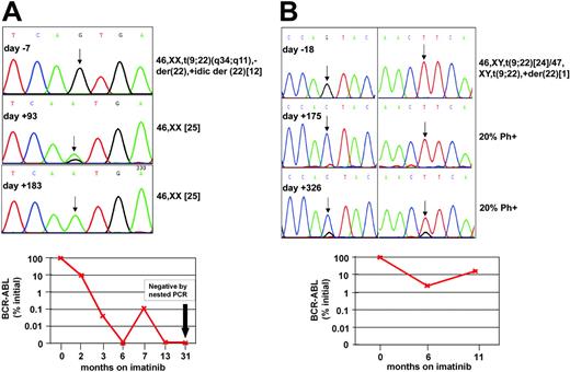 Figure 2. Follow-up of patients no. 13 and no. 41. (A) Patient no. 41. (Top) Sequence analysis of PCR products on days -7, +93, and +183 of imatinib therapy. ASO-PCR detected T315I on day -7, while conventional sequencing was negative. A mix of T315I and wild type (arrow) was detected on day +93, the time of first documented complete cytogenetic response. On day +183, only T315I was detected, while the patient remained in complete cytogenetic remission. (Bottom) Follow-up with quantitative and qualitative RT-PCR showed a gradual although not uninterrupted decrease of BCR-ABL transcripts and eventually complete molecular remission. (B) Patient no. 13. (Top) Sequence analysis of PCR products on days -18, +175, and +316 of imatinib therapy. ASO-PCR detected Q252H in the specimen from day -18. One hundred percent Q252H was detected on day +175 (left chromatogram, arrow). On day +326, a mix of Q252H and F359V was detected (arrows). Note that a small wild-type signal has reemerged in position 252. (Bottom) Follow-up with quantitative RT-PCR for BCR-ABL.