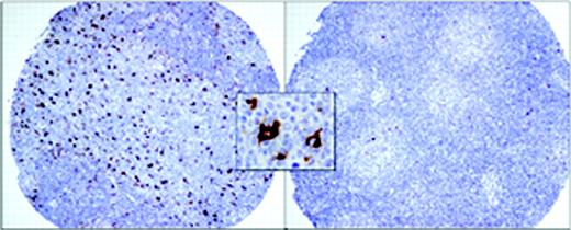 Figure 1. Representative tissue microarray cores of patients with follicular lymphoma. The image on the left shows the uncommon finding of large numbers of macrophages both within and surrounding neoplastic follicles (n = 12). The image on the right shows the more common finding of very few macrophages (n = 87). The insert shows the typical strong cytoplasmic staining of reactive macrophages with anti-CD68 antibody. Images were acquired using a Nikon Eclipse E600 clinical microscope and Dxm1200 digital camera and software (Nikon, Tokyo, Japan). Original magnification × 100 (objective, 10 ×/0.3 NA) for the larger panels and × 1000 (objective, 100 ×/1.3 NA) for the insert.