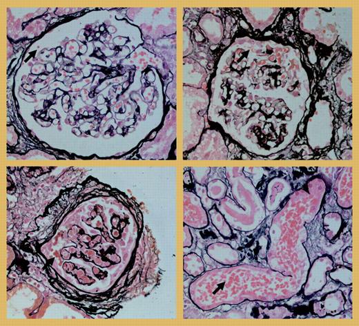 “Glomerular hemorrhage” in a kidney biopsy of a patient with crescentic glomerulonephritis and anti-MPO antibodies, in an almost normal glomerulus (top left), in a glomerulus with beginning extracapillary proliferation (top right), and in a glomerulus with chronic lesions (bottom left). At the bottom right, erythrocytes from a glomerulus are present in a tubule.