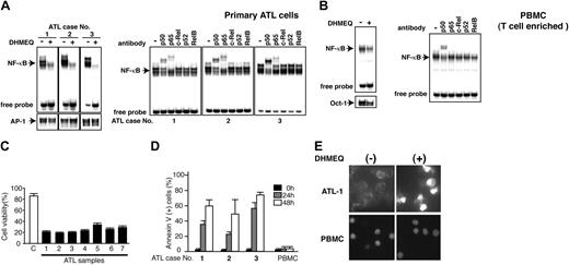 Figure 4. DHMEQ inhibits constitutive NF-κB activity and induces apoptosis of primary ATL cells. (A) EMSA and supershift analyses. (Left upper 3 panels) DHMEQ inhibition of constitutively activated NF-κB in 3 samples of primary ATL cells. Cells were treated with or without 10 μg/mL DHMEQ for 16 hours. Positions of shifted bands and free probes are indicated on the left. (Left lower 3 panels) Results of EMSA with AP-1 probe. (Right 3 panels) Supershift analysis of NF-κB components in 3 samples of primary ATL cells. Nuclear extracts of ATL samples were subjected to supershift analysis with antibodies specific for p50, p65, c-Rel, p52, and RelB. (B) EMSA of DHMEQ effects on T cell-enriched normal PBMCs and supershift analysis of NF-κB components. (Left panel) Nuclear extracts were prepared after 16 hours of treatment with or without 10 μg/mL DHMEQ. Results of control EMSA with an OCT1 probe are shown at the bottom. (Right panel) Supershift analysis of NF-κB components using antibodies indicated above the gel. The position of shifted bands is indicated on the left. Antibodies used are indicated on the top. (C) Effects of DHMEQ on the viability of primary ATL cells. Cells were treated with 10 μg/mL DHMEQ for 48 hours. Cell viability was measured by MTT assay, and the relative levels compared with those of DMSO-treated cells are presented. Data represent the mean ± SD of 3 independent experiments. (D) Detection of apoptosis by annexin V. Three ATL samples and normal PBMCs were treated with 10 μg/mL DHMEQ, and binding of FITC-conjugated annexin V was analyzed by flow cytometry after 24 or 48 hours. Data represent the mean ± SD of 3 independent experiments. (E) Changes in the nuclear morphology by DHMEQ treatment. Primary ATL cells and control PBMCs were treated with 10 μg/mL DHMEQ for 24 hours and stained with Hoechst 33342. Original magnification ×400. Objective lens, 60×/4.4.