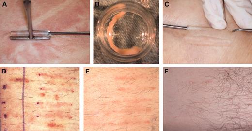 Figure 1. Harvesting, ex vivo culturing, implantation, and after implantation steps of the Biopump in patients. (A) The harvesting step. (B) The Biopump ex vivo at the transduction step. (C). Implantation of the Biopump. (D) Implantation area 1 week after implantation. (E) Implantation area 4 weeks after implantation. (F) Implantation area 18 weeks after implantation.