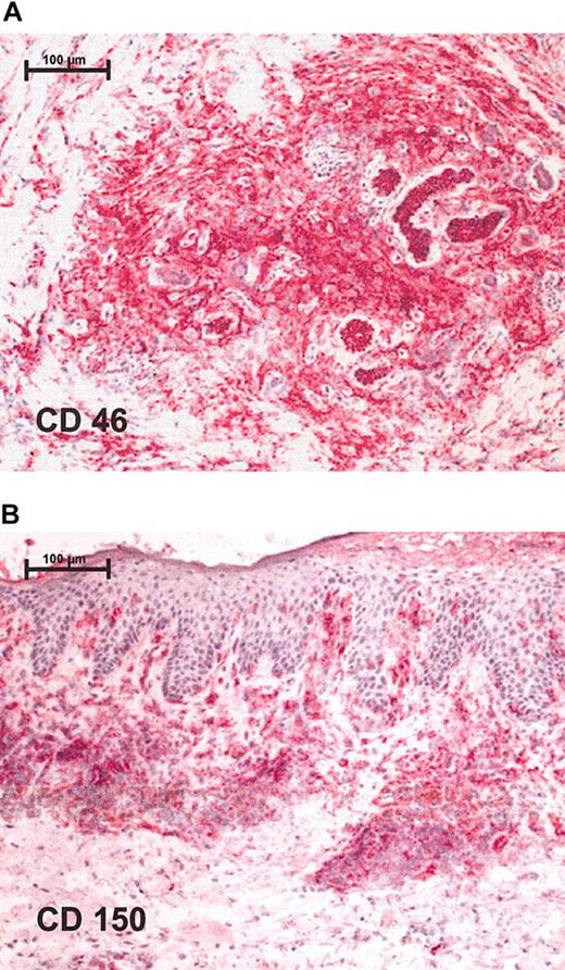 Figure 1. Immunohistochemistry shows positive staining for measles receptors in CTCL lymphoma biopsies. Red staining represents lymphocytes that express respective receptor (A) CD46 and (B) CD150. Stainings were performed on cryostat sections and were assessed together with contiguous slices stained for CD4 and CD8. Original magnification, × 100 (scale bar indicates 100 μm). Images were visualized under an Axiophot light photomicroscope (Zeiss, Jena, Germany) equipped with a 10 × objective lens and a 10 × ocular.