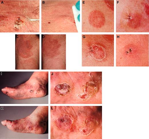 Figure 3. Clinical presentations. The injected lesion (A) and a representative noninjected plaque (C) of patient 1 before (A,C) and after (B,D) treatment with intratumoral injection of measles vaccine virus preceded by subcutaneous IFN-α application. (E) The first injected plaque lesion of patient 2 before therapy, (F) after 6 days presenting edematous swelling and inflammation, (G) after 12 days and (H) clearing after 28 days. Thereafter, a tumor lesion was treated (I, overview) and (J, detail), again resulting in regression (K, overview; L, detail). The tumor lesions showed reduction in size and thickness after therapy. Images were acquired with a Leica RG camera (Leica, Jena, Germany).