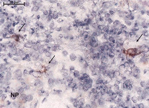 Figure 4. Immunoreactivity for the virus as demonstrated by peroxidase staining for the measles nucleoprotein immunohistochemically. Magnification, × 100 (scale bar indicates 100 μm). Arrows indicate immunoreactivity for nucleoprotein (NP).