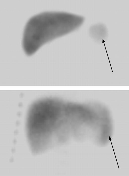 Figure 2. Radionuclide liver-spleen scan showing normalization of splenic uptake after extended hydroxyurea therapy. A 7-month-old child with markedly decreased splenic uptake at baseline (arrow in top panel) regained splenic uptake after 4 years of hydroxyurea therapy (bottom panel). The arrow in the lower panel denotes the location of splenic uptake and indicates a slightly enlarged spleen measuring 9.3 cm in length.